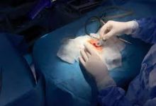 Photo of أطباء يعيدون الأمل لأطفال مرضى